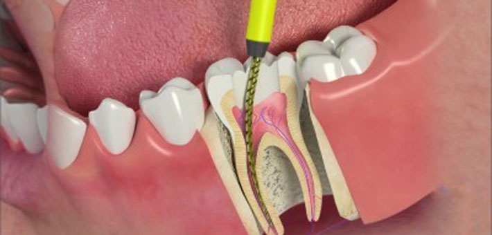 http://13002treat.com.au/images/img-root-canal-therepy.jpg